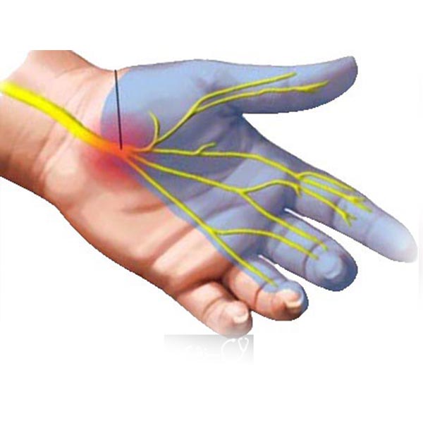 گرفتگی کانال دست