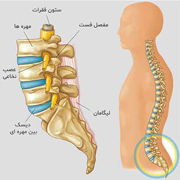درمان دیسک کمر